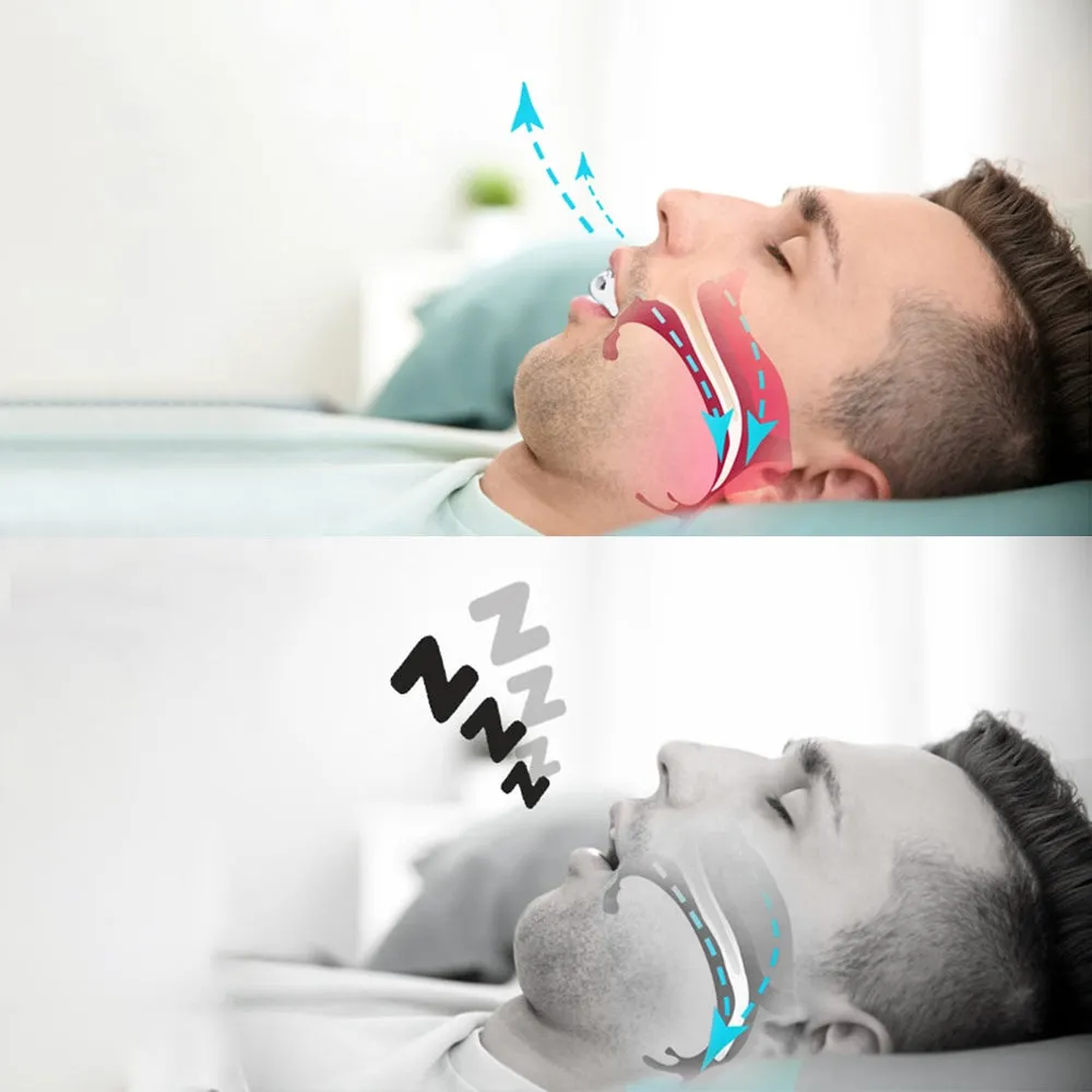 Anti-Snoring Corrective Breath Positioning Mouth Night Guard